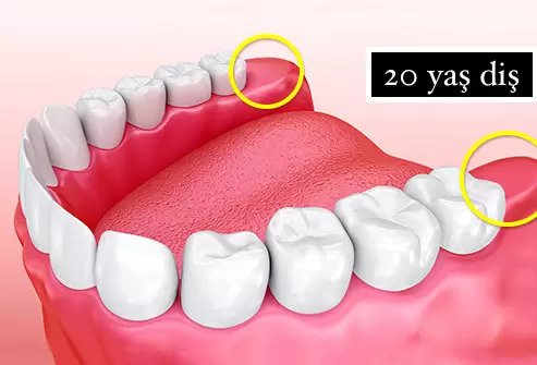 Wisdom Tooth Symptoms and Surgery