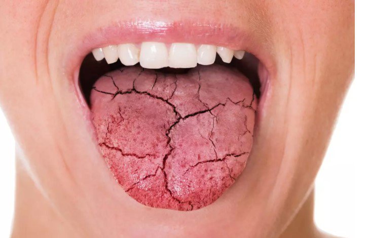 What Causes Dry Mouth?