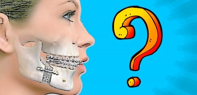 What is Jaw Clicking or Popping?