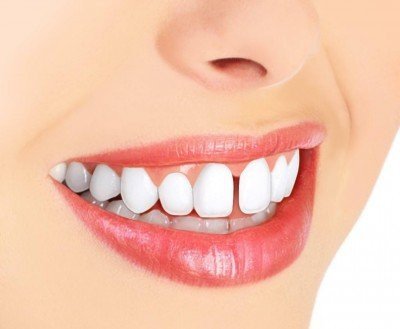 Treatment of Separated Teeth (Diastema)