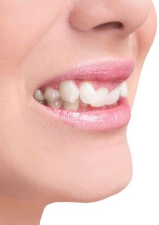 Çapraşık Diş Tedavisi