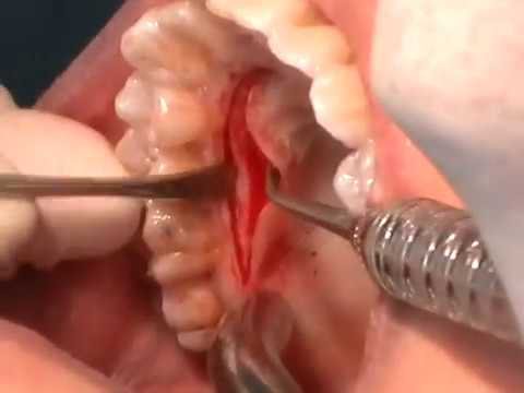 Taking Flesh from the Palate to Create Gum Tissue.