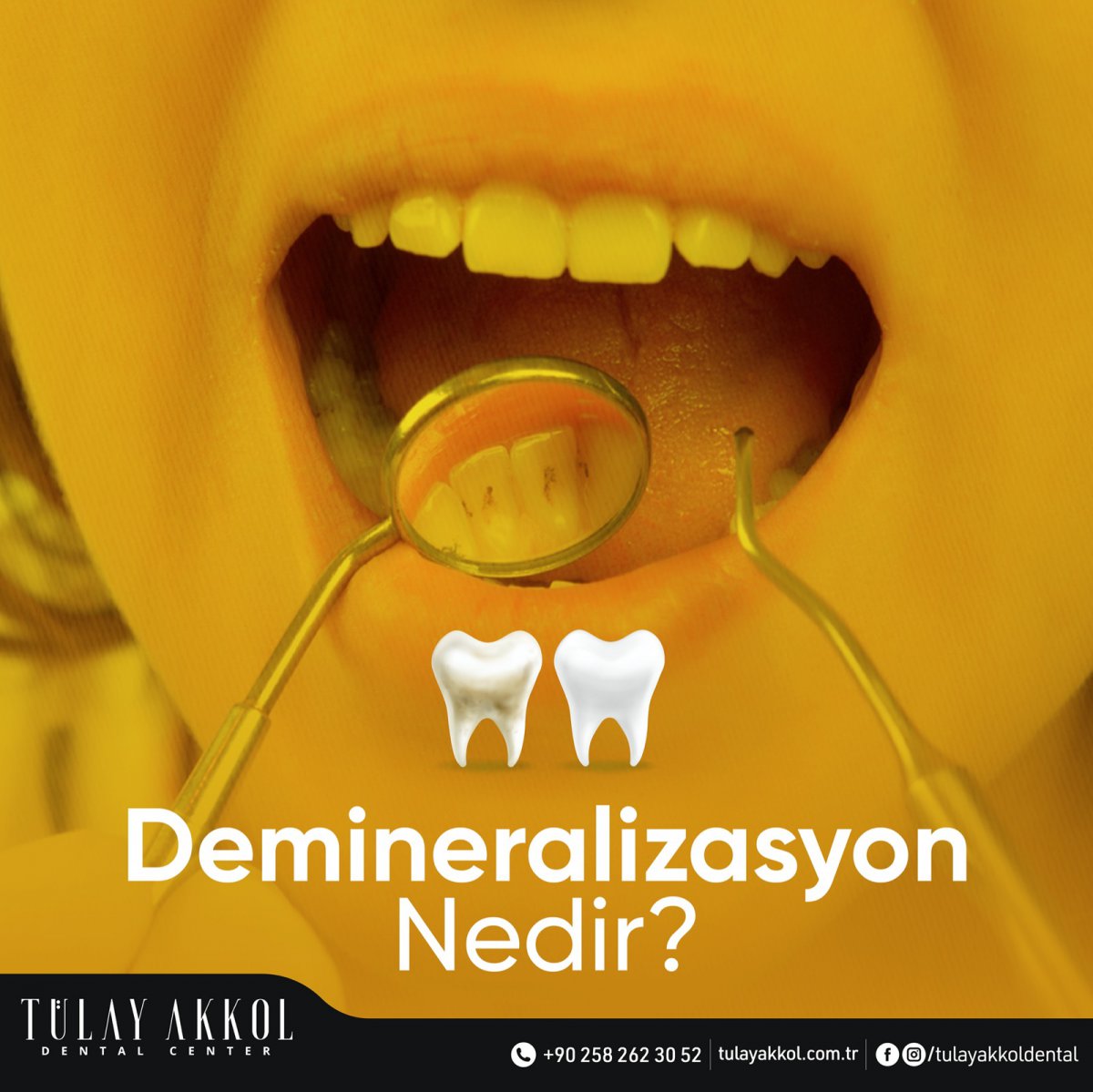 What is Demineralization?