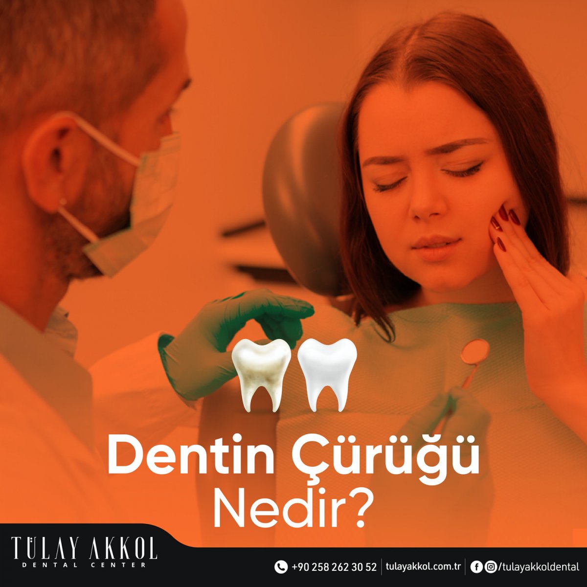 What is Dentin Caries?