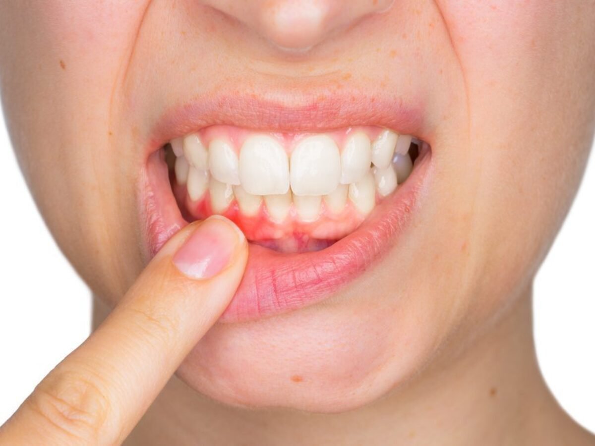 What is a Tooth Abscess? How does it Go Away?