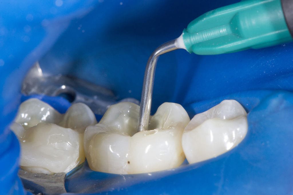 Why are Dental Fillings Done?