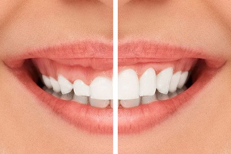 What is Good for Receding Gums?