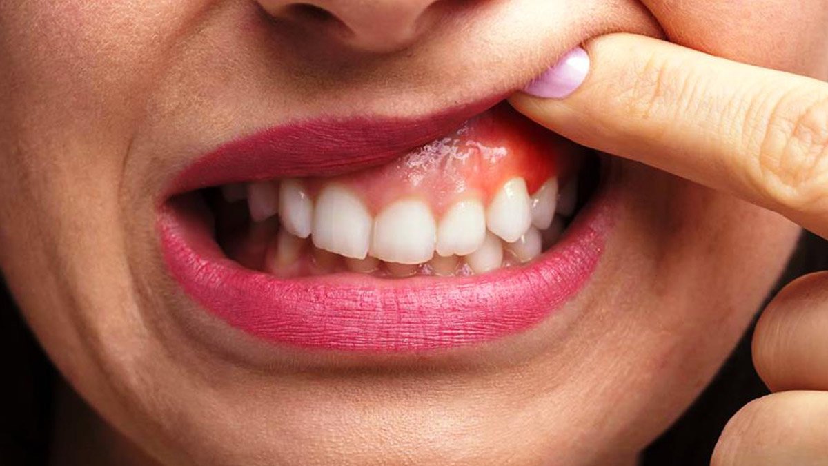 Diş Eti Şişmesi Nasıl Geçer?