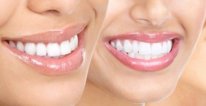 Diş Kaplama Çeşitleri