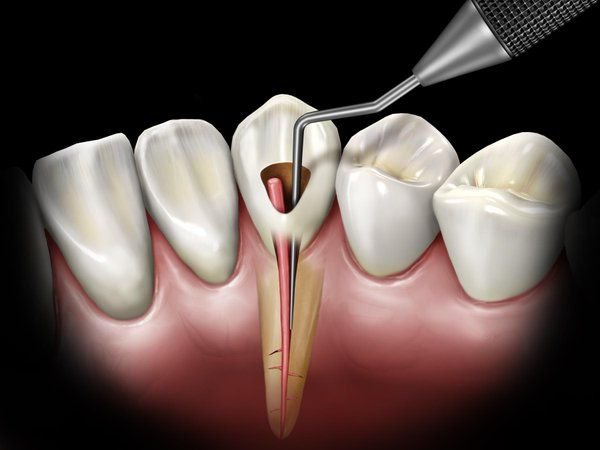 How is the Dental Nerve Removed?