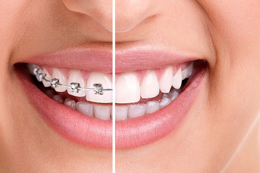 20 Things You Should Know Before Starting Orthodontic Treatment