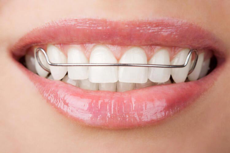 Do Braces Affect Speech?