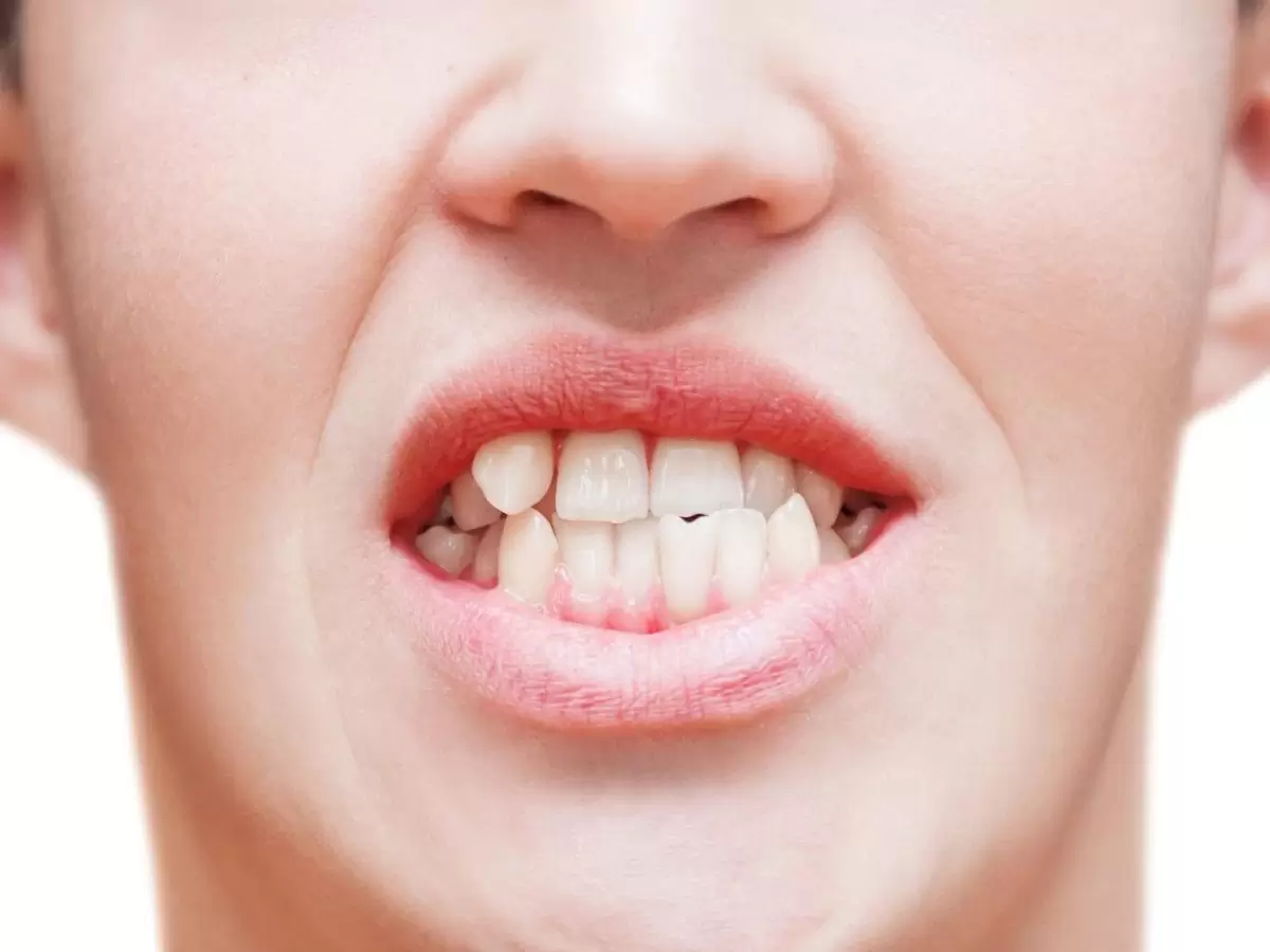 Why do Teeth Become Crooked (Misaligned)?