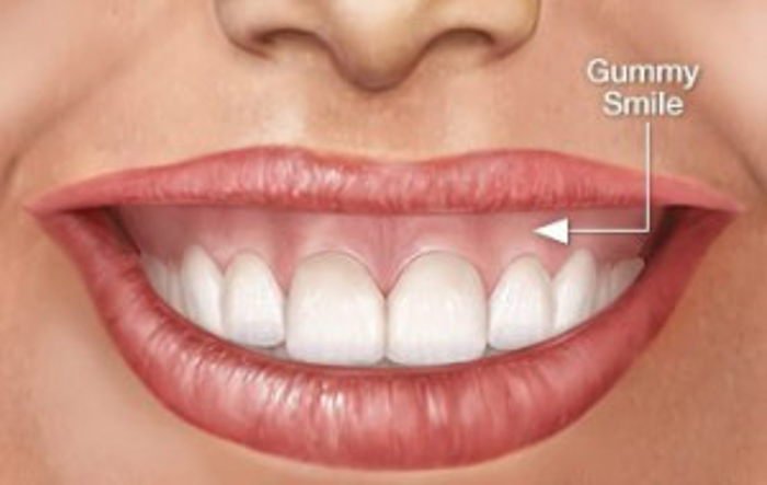 What is Gummy Smile?