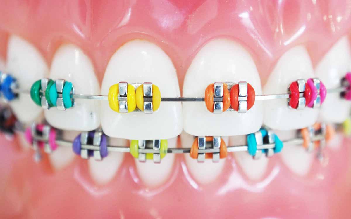 What are the Different Colors of Braces Available? Which One is Best for You?