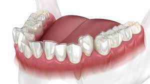 What makes Invisalign Clear Aligners Treatment Different from Others?