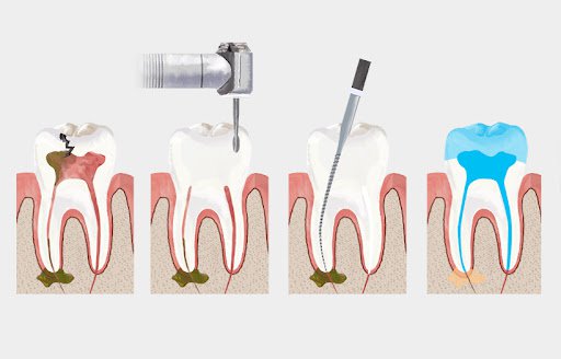 What is Root Canal Treatment?