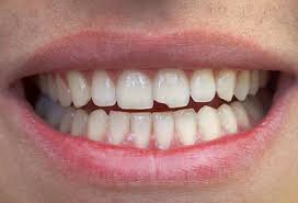 What Happens if the Root of a Broken Tooth Remains?