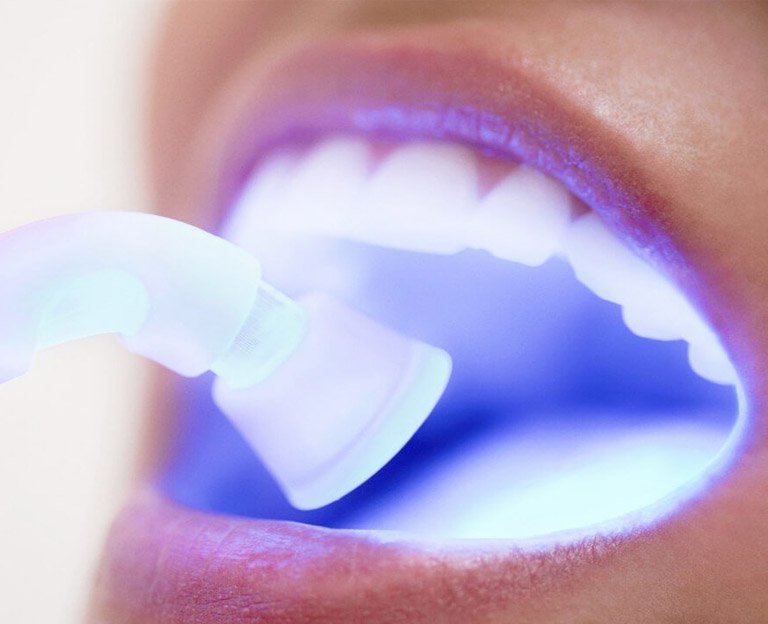 Laser Teeth Whitening