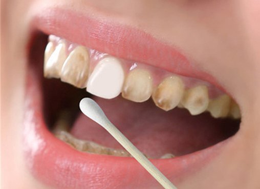 What Should be Done to Whiten Yellowed Teeth?