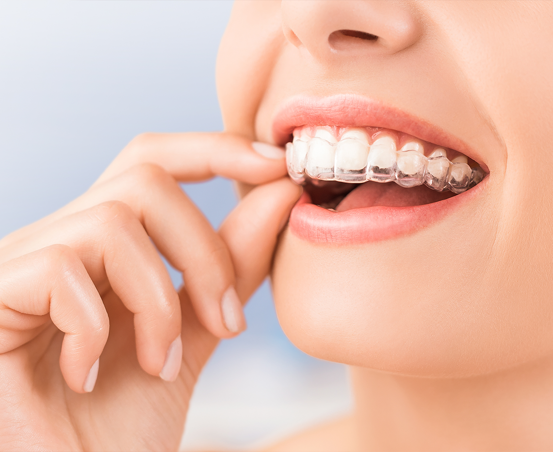 Clear Aligner Treatment